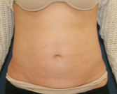 Feel Beautiful - TummyTuck LA - Before Photo